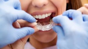 cómo funciona la ortodoncia invisible