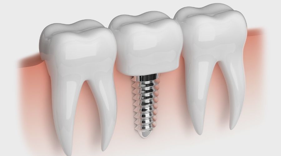 Consejos para cuidar los implantes dentales