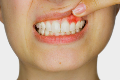 Qué síntomas puede presentar un flemón dental